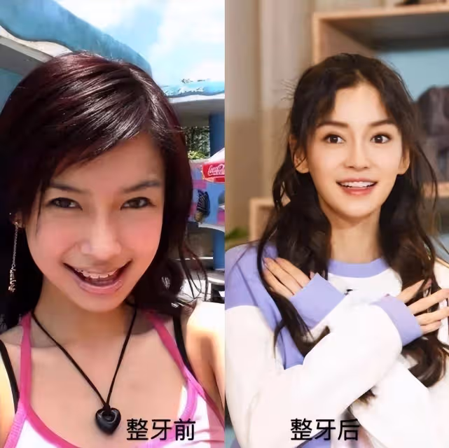 劉雯被質疑瘦過頭本人霸氣回應剛拔智齒，網友的反應太真實了