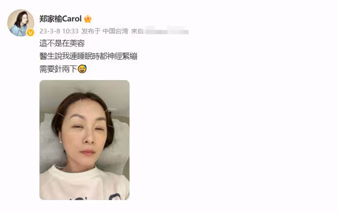 鄭家榆臉上扎滿針,自曝精神很差!51歲仍未婚,羨慕別人結婚生娃