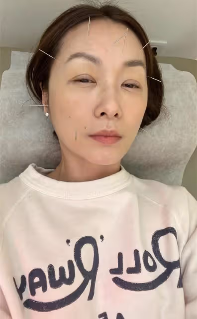 鄭家榆臉上扎滿針,自曝精神很差!51歲仍未婚,羨慕別人結婚生娃