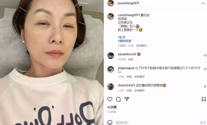 鄭家榆臉上扎滿針,自曝精神很差!51歲仍未婚,羨慕別人結婚生娃