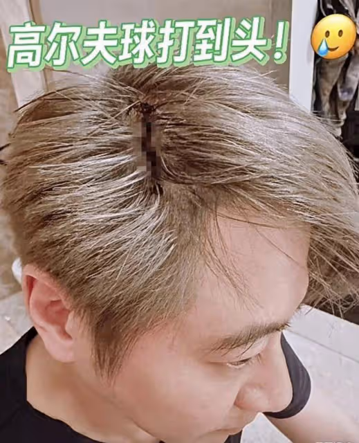 心疼!知名港星曬頭部受傷照,傷口長約5厘米,面色惹人憂