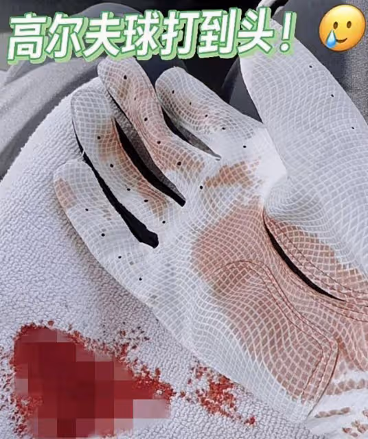 心疼!知名港星曬頭部受傷照,傷口長約5厘米,面色惹人憂