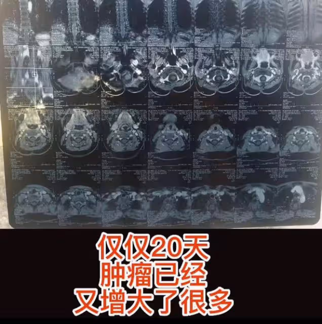 9歲抗癌網紅小旭去世,8年抗癌艱難生涯,歷經3次開顱手術6次化療