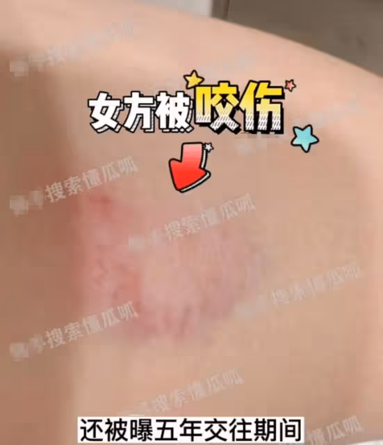 醜聞大瓜!5年女友淚訴蒙恩有特殊癖好咬傷自己,偷偷劈腿女富婆
