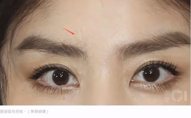 陳慧琳車禍3月後首現身，面部僵硬險毀容，留疤自曝未找整容醫生