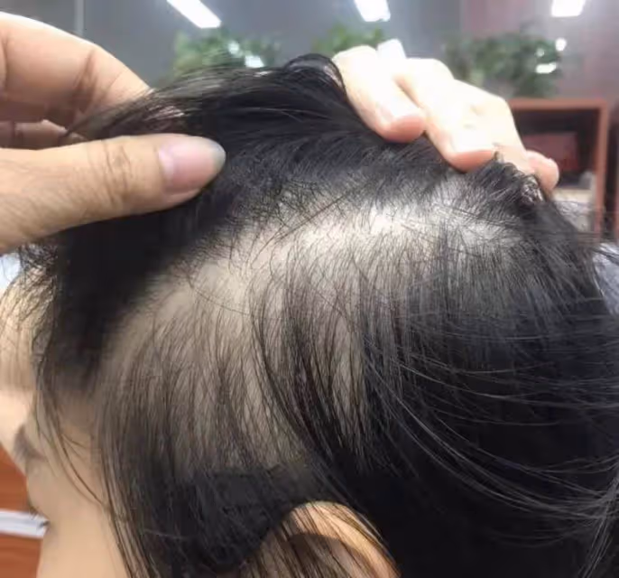 頭頂越洗越禿？做好這三步，洗完不掉發，碎發還能滿頭炸！