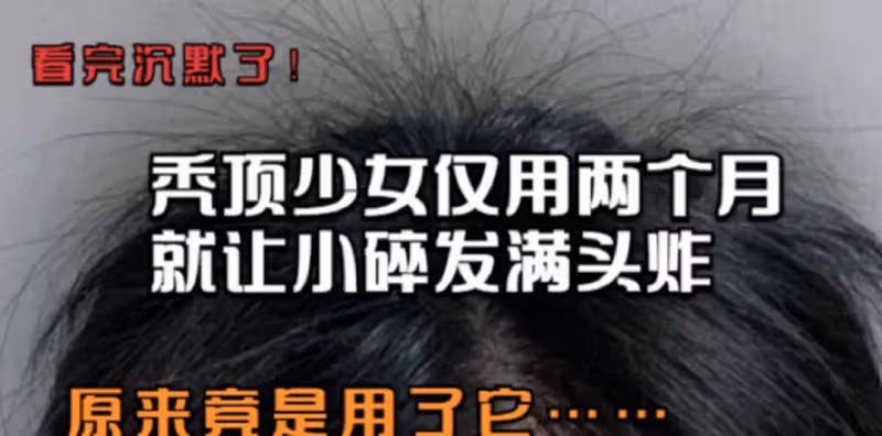 頭頂越洗越禿？做好這三步，洗完不掉發，碎發還能滿頭炸！