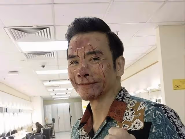 TVB知名男星疑患病，近照面頰凹陷身材消瘦，割膽手術致氣血不足
