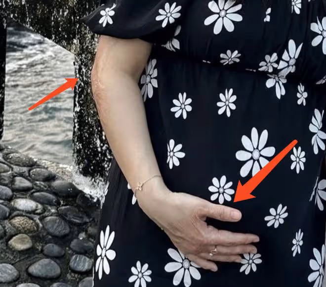 Selina曬全家出遊照,手捧孕肚出鏡,手臂燒傷疤痕曝光太讓人心疼