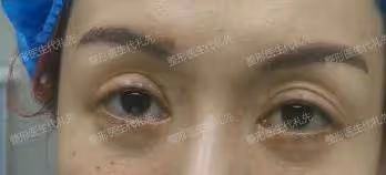 40~60歲值得做的醫美項目：外切眼袋手術