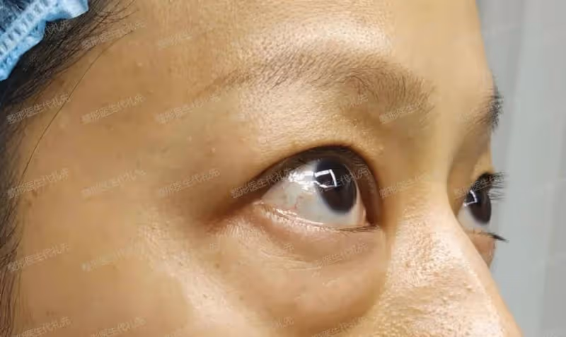 40~60歲值得做的醫美項目：外切眼袋手術