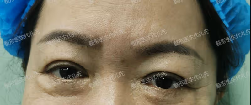 40~60歲值得做的醫美項目：外切眼袋手術