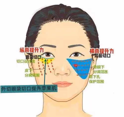 40~60歲值得做的醫美項目：外切眼袋手術