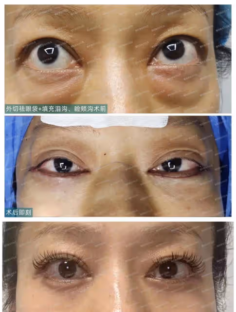 40~60歲值得做的醫美項目：外切眼袋手術