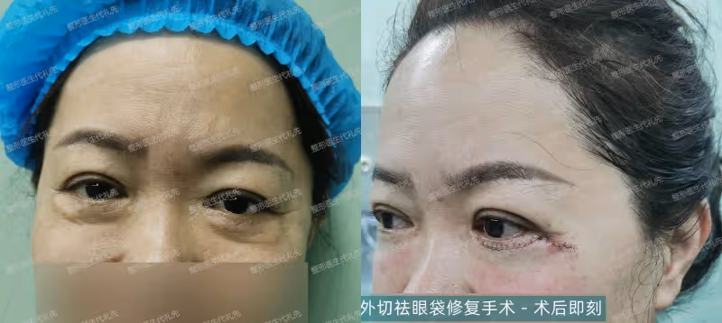 40~60歲值得做的醫美項目：外切眼袋手術