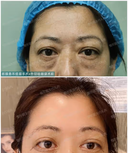 40~60歲值得做的醫美項目：外切眼袋手術