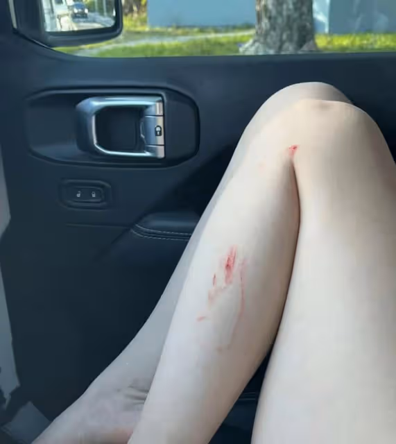 楊麗萍外甥女小彩旗變瘦了！穿短褲露白皙美腿，獨居英國意外受傷