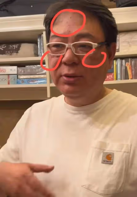 密恐慎點!高亞麟額頭長滿黑點惹擔憂,自曝生病許久疑似感染HPV