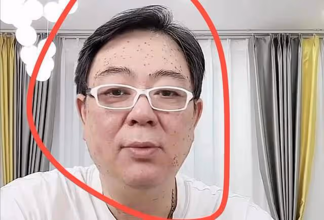 密恐慎點!高亞麟額頭長滿黑點惹擔憂,自曝生病許久疑似感染HPV