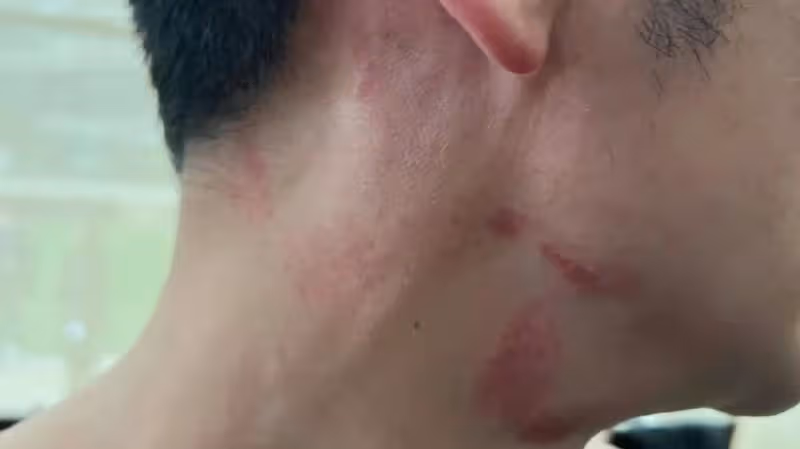 李晨方闢謠，是受傷不是唇印，已經不是第一次受傷了