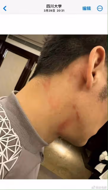 李晨方闢謠,是受傷不是唇印,已經不是第一次受傷了