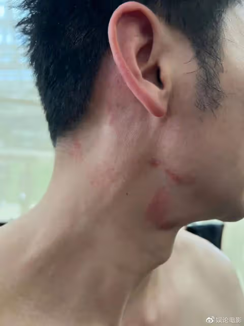 李晨方闢謠,是受傷不是唇印,已經不是第一次受傷了