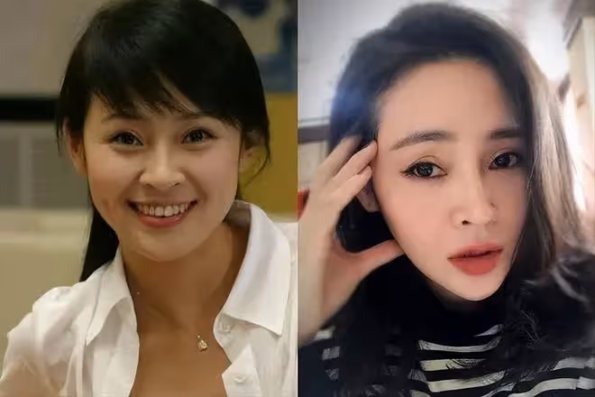 40歲愛上了整容,後遺症凸顯,於明加終於明白自己被醫美坑慘了