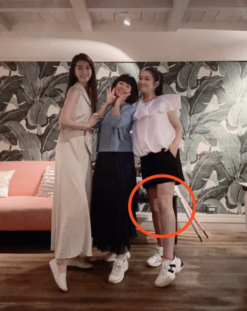 任家萱過母親節罕見穿短褲,雙腿燒傷疤痕暴露無遺,粉絲直呼心疼