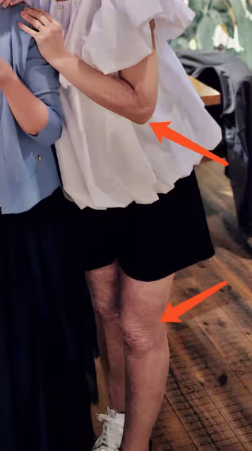任家萱過母親節罕見穿短褲,雙腿燒傷疤痕暴露無遺,粉絲直呼心疼