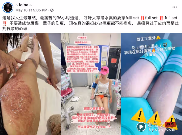 馬來西亞美女DJ潛水遭海葵蟄傷!曬恐怖傷痕 「好像被火燒的感覺」