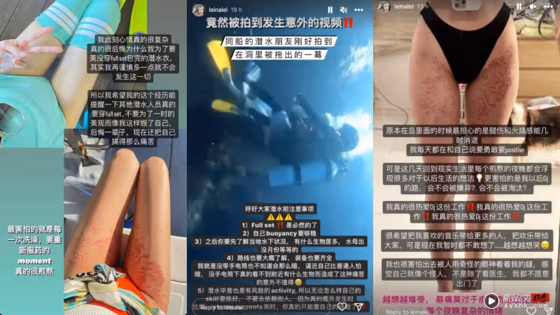 馬來西亞美女DJ潛水遭海葵蟄傷!曬恐怖傷痕 「好像被火燒的感覺」