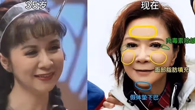 61歲整容上癮,後遺症凸顯,蔡明終於知道自己被醫美坑慘了