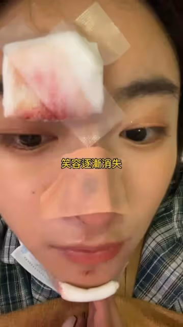 香港新一代女神受傷毀容!逛街突然暈倒臉撞地,急花9萬做手術