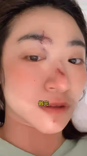 香港新一代女神受傷毀容!逛街突然暈倒臉撞地,急花9萬做手術