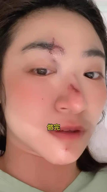 香港新一代女神受傷毀容！逛街突然暈倒臉撞地，急花9萬做手術