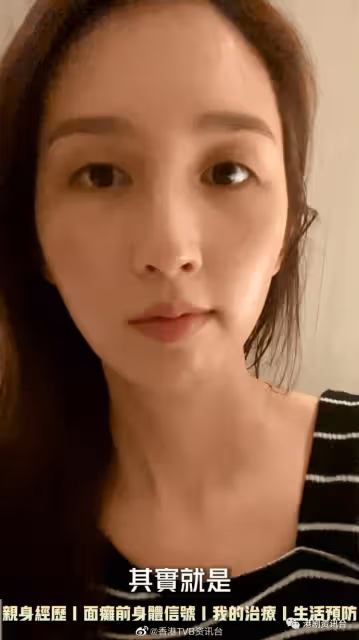 前TVB小花消失原來是這個原因!曾是絕美臉蛋卻患上面癱