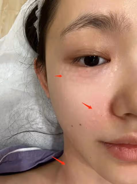27歲林允公開醫美過程,為去皺紋臉上扎滿針眼,直呼醫美需謹慎