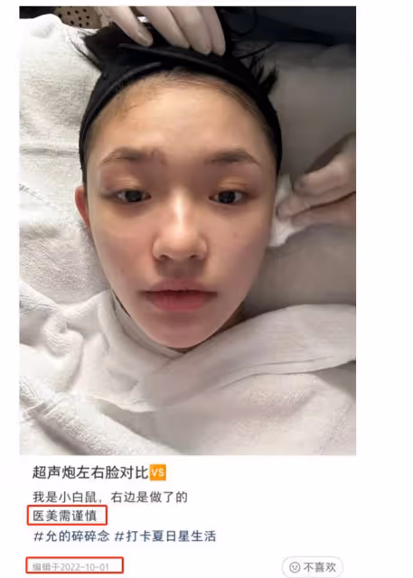 27歲林允公開醫美過程,為去皺紋臉上扎滿針眼,直呼醫美需謹慎