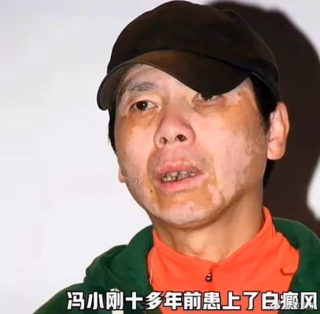 65歲馮小剛白癜風痊癒？自稱沒用任何藥，但頭皮離奇禿了一大片