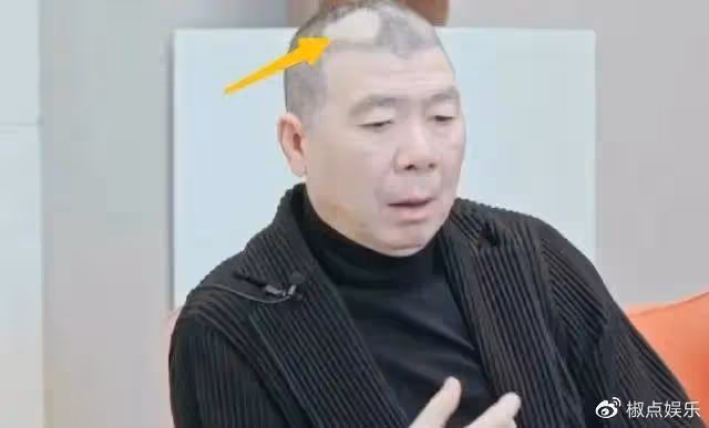 65歲馮小剛白癜風痊癒？自稱沒用任何藥，但頭皮離奇禿了一大片