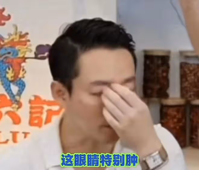 汪小菲暴瘦引擔憂!眼睛紅腫歐式大雙矚目,剛摔骨折又被疑得甲亢