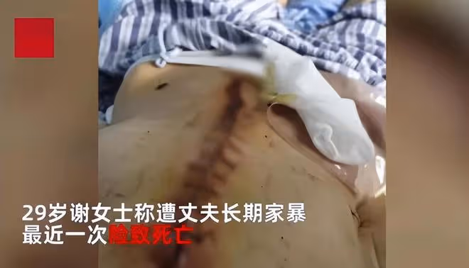 29歲女子遭家暴致殘:被折磨9小時,腸子被打斷,內臟被糞便污染