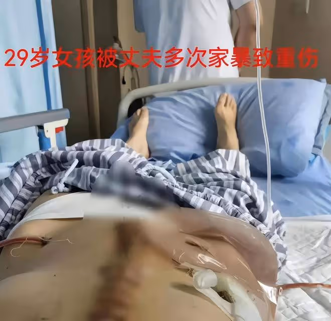 29歲女子遭家暴致殘:被折磨9小時,腸子被打斷,內臟被糞便污染