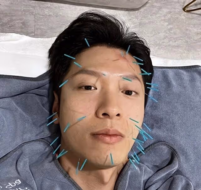 知名港星拼事業無暇休息!曝面部生蛇需針灸,打針時一度鬧出笑話