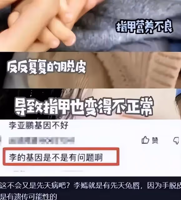 李亞鵬小女夏夏病情疑加重,走起來雙腿不對勁,與姥爺互動慢半拍