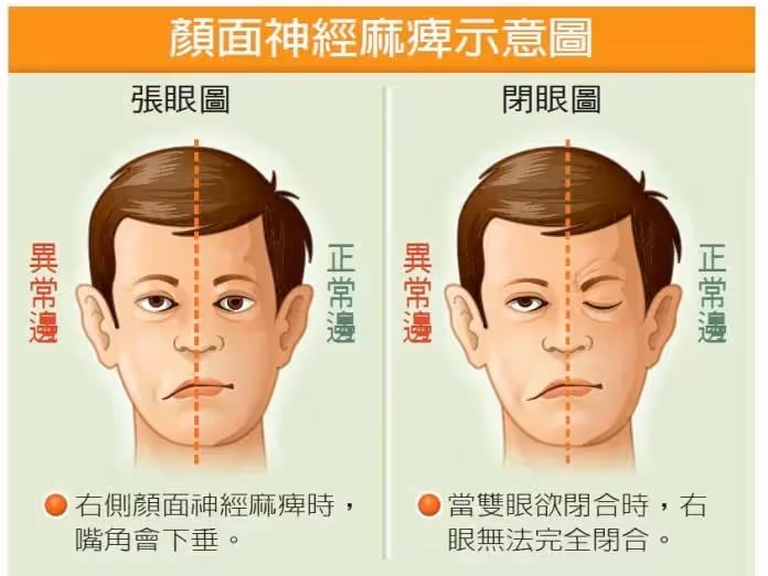 突然臉歪嘴斜！63歲綜藝大哥大「錄影一半感到不對勁」 「病發畫面曝光」超驚悚：真的不能拖…