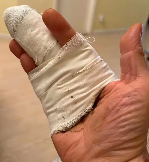 「西門慶」單立文近況引擔憂!受傷4個月仍未痊癒,手指纏滿紗布