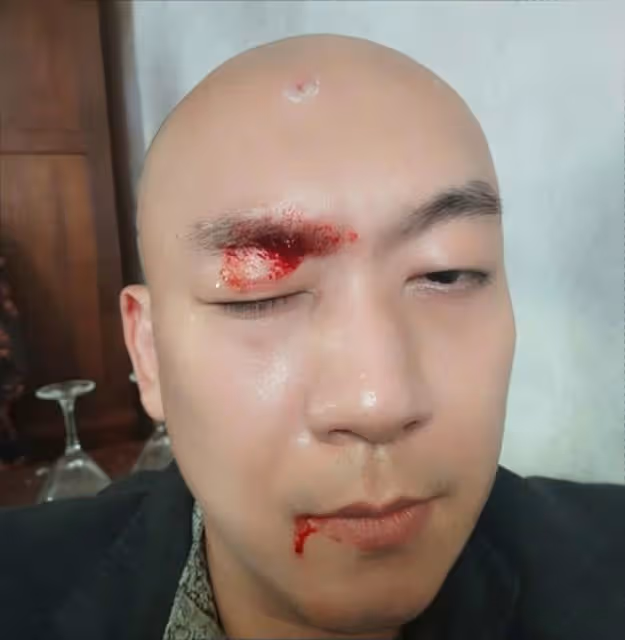 突發!TVB知名男星在內地拍戲不慎受傷,被落地燈擊中血流不止