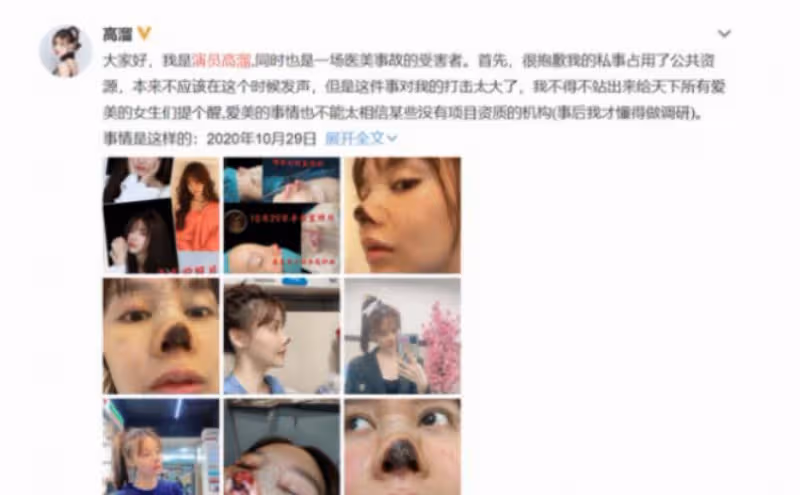 又有網紅整容失敗!從蕭薔、張檬到景甜,美女們別再折騰臉了