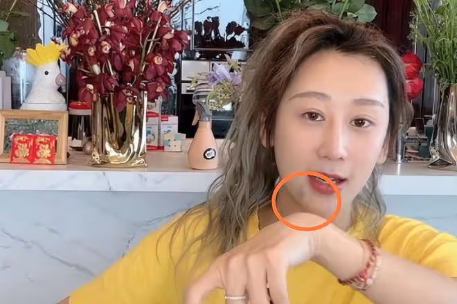 蔣麗莎帶傷直播疑被家暴?下巴淤青、鼻紅腫,曾當眾嫌陳浩民無能